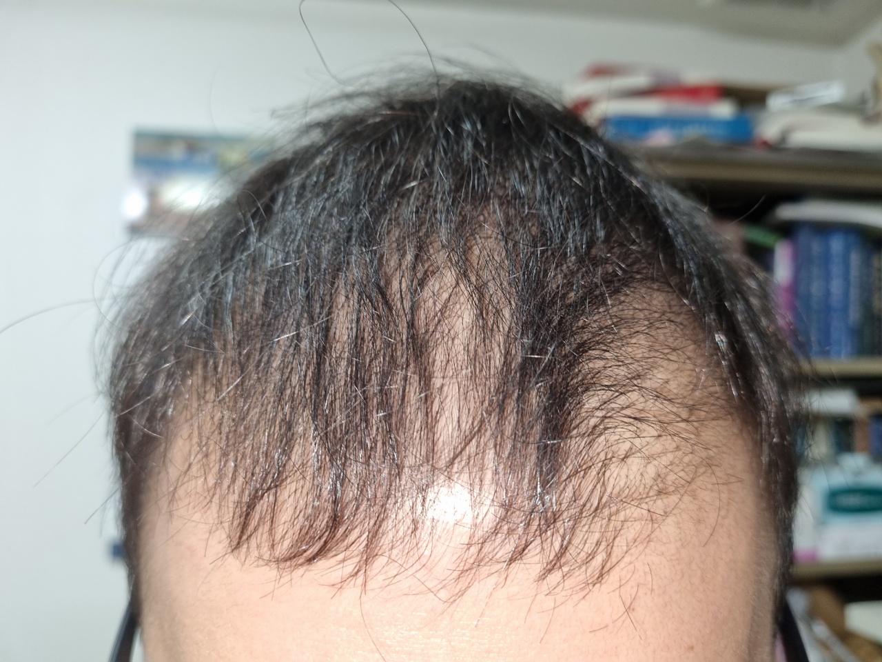 식약처 탈모 예방치료 샴푸 없어