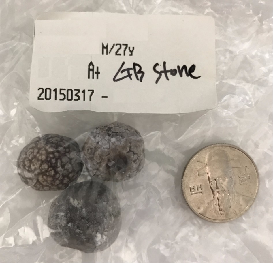 몸에서 적출한 알 인증_1.jpg