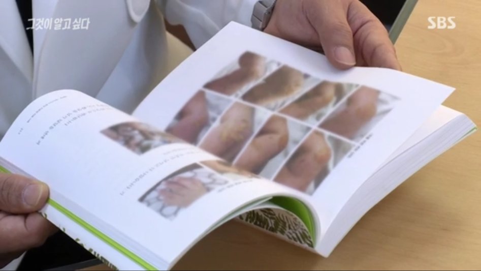 안아키식 화상 치료법_13.png