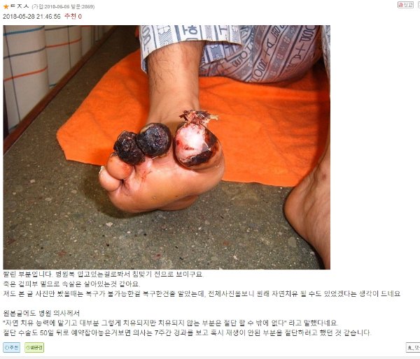 약혐일수도?)베스트간 침술로 괴사 치료하는짤이 웃긴점.jpg_2.jpg