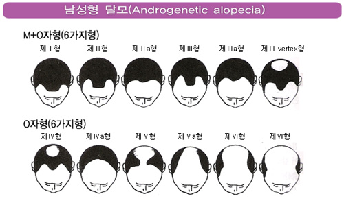 남성형탈모의종류.jpg