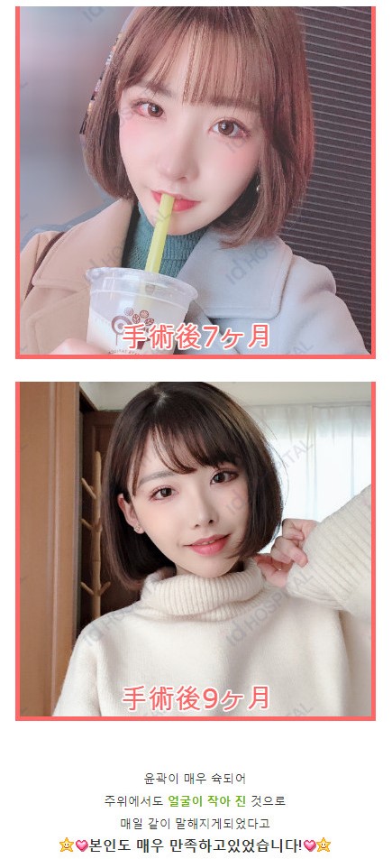 한국 성형외과에서 수술받은 AV배우_7.jpg