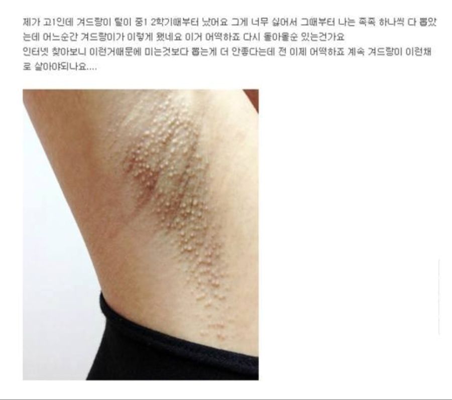 혐주의) 겨드랑이 털을 쪽집게로 뽑으면 안되는 이유.jpg_1.jpg