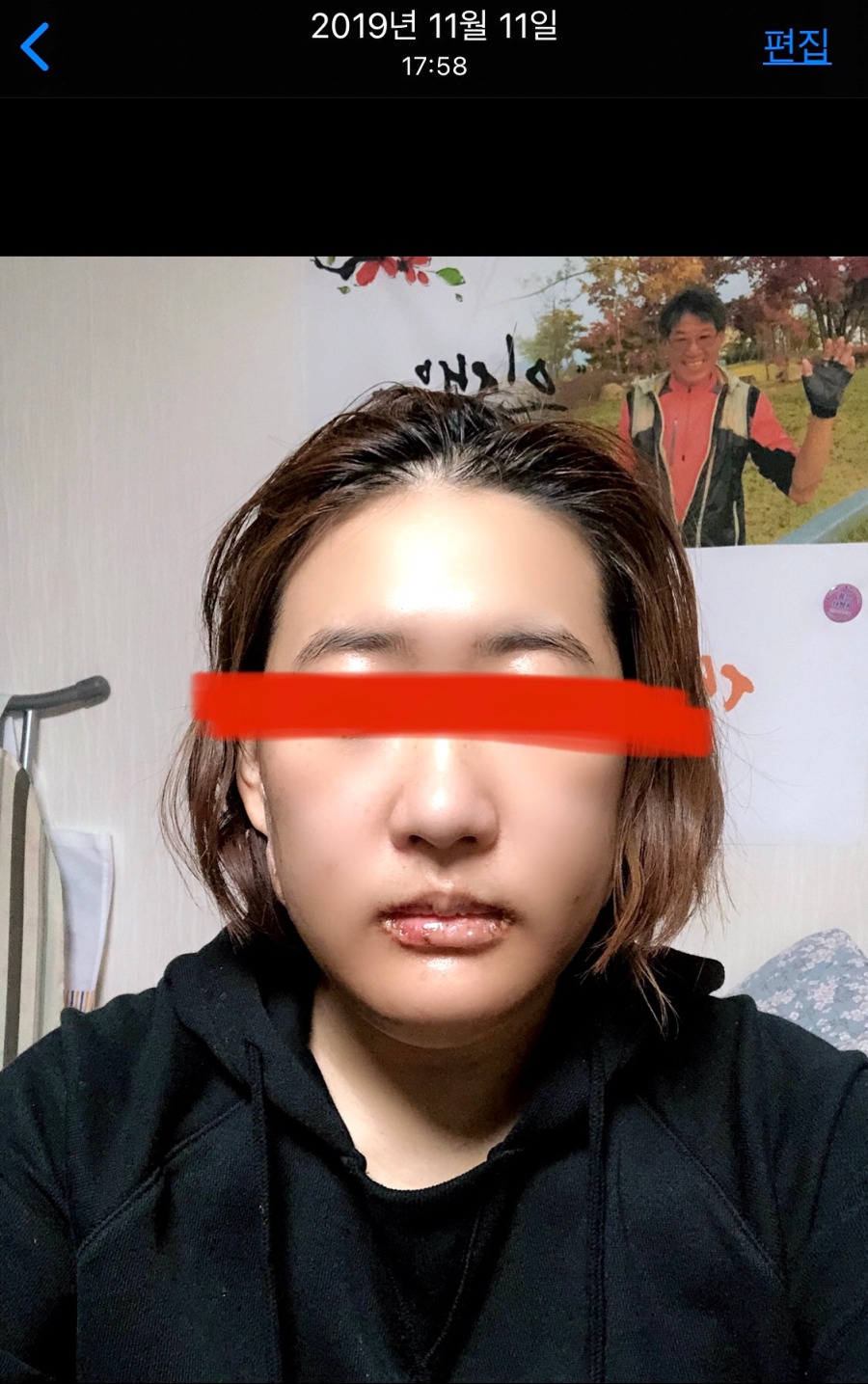 양악수술 후 곧 8개월차 전후비교