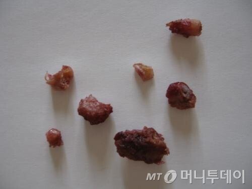 투수의 팔에서 나오는 뼛조각_2.jpg