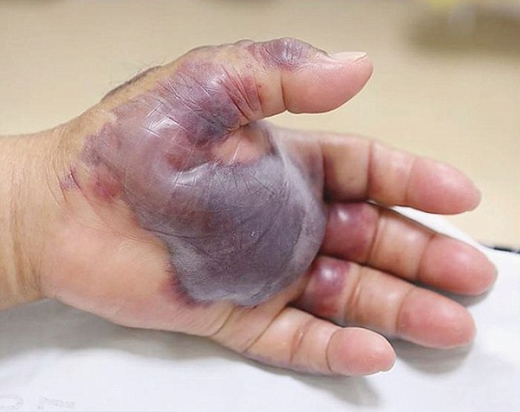 약혐) 겨울철 의외로 생각보다 위험한 음식_3.jpg