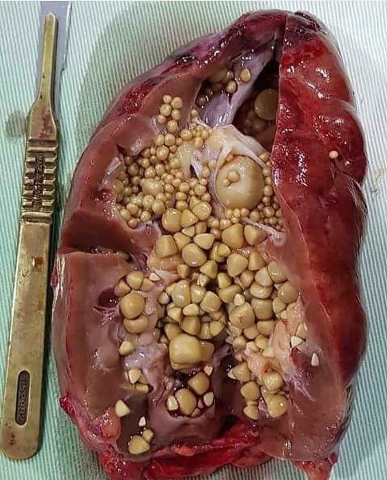 약혐) 요로결석의 끝판왕 [녹각석]_1.jpg