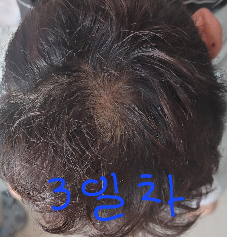 탈모) 먹는약 3일차_1.jpg