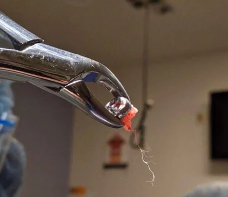 발치한 치아에 신경이 같이 딸려나온 사진_1.png