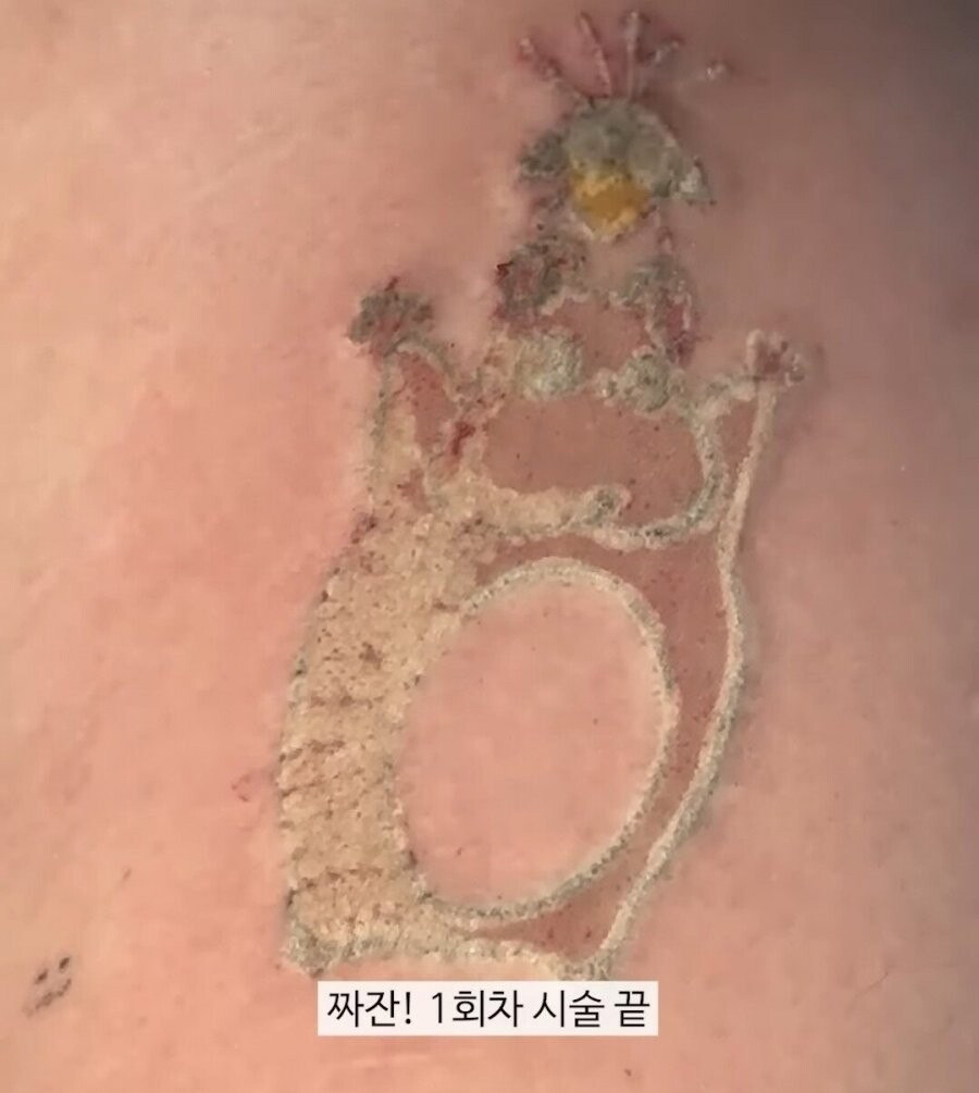 혐오) 문신 제거시술 장면.avi_1.jpg