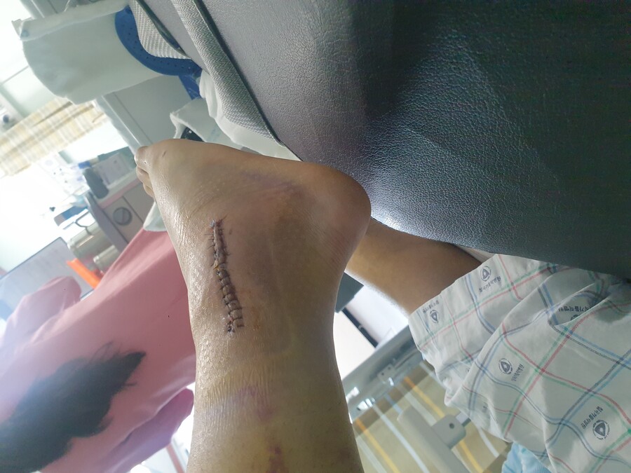 혐 스압 )내 다리 상태가 유머_4.jpg