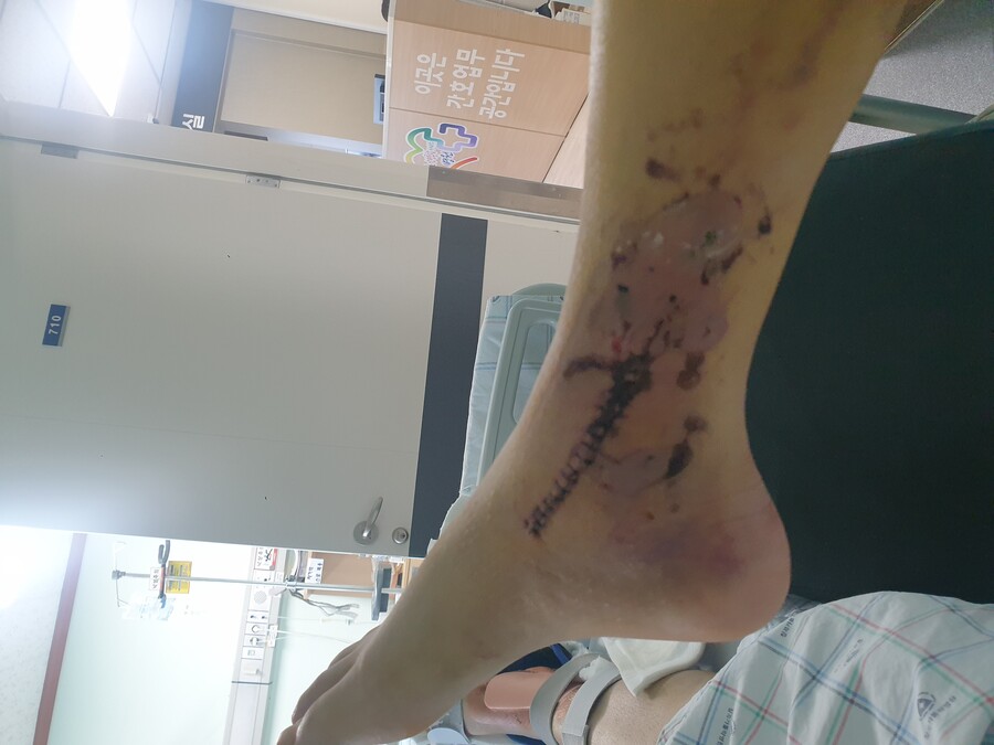 혐 스압 )내 다리 상태가 유머_5.jpg