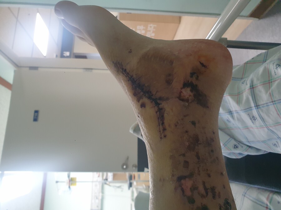 혐 스압 )내 다리 상태가 유머_6.jpg