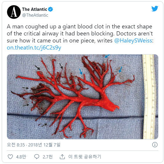 재채기 하다가 나온 온전한 피떡