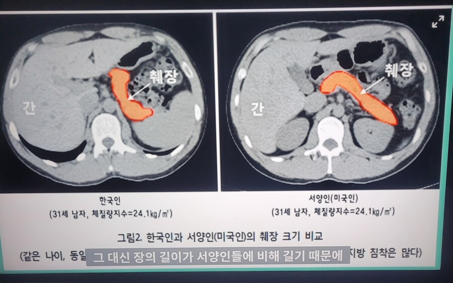 동양인과 서양인의 췌장크기 차이_1.jpg
