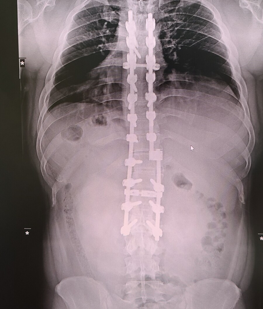 척추변형증 (척추측만증, 후만증)에 대한 잘못된 상식_2.jpg