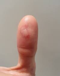 의사들이 말하는 손에 화상입고 물집 생길때 대처법.._1.jpg