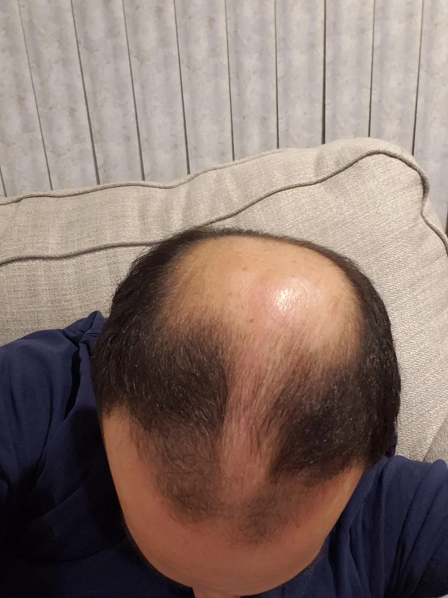 외국에 머리민 사람들이 많은 이유.jpg_2.webp