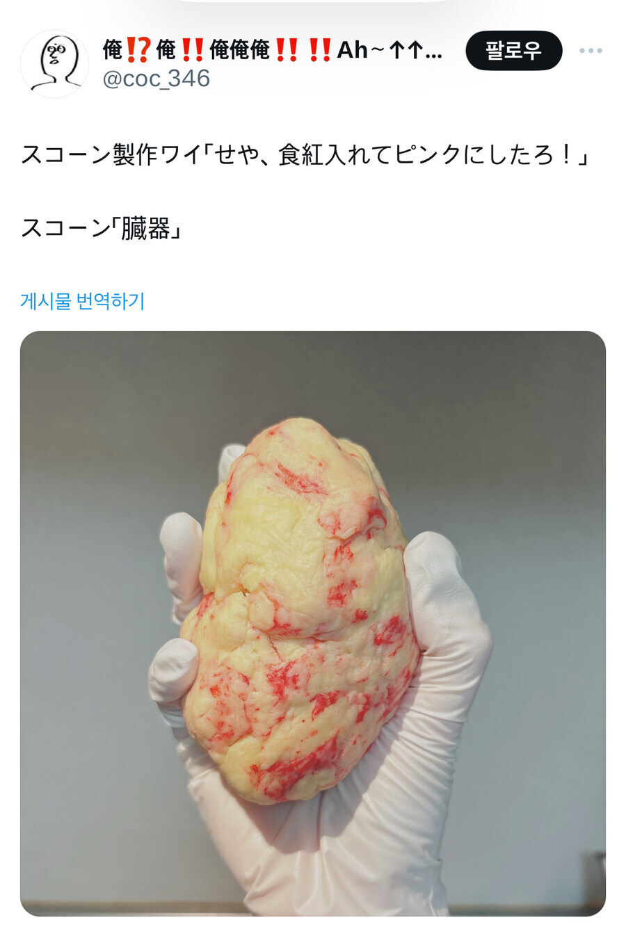 적출된 지방.jpg_1.jpg