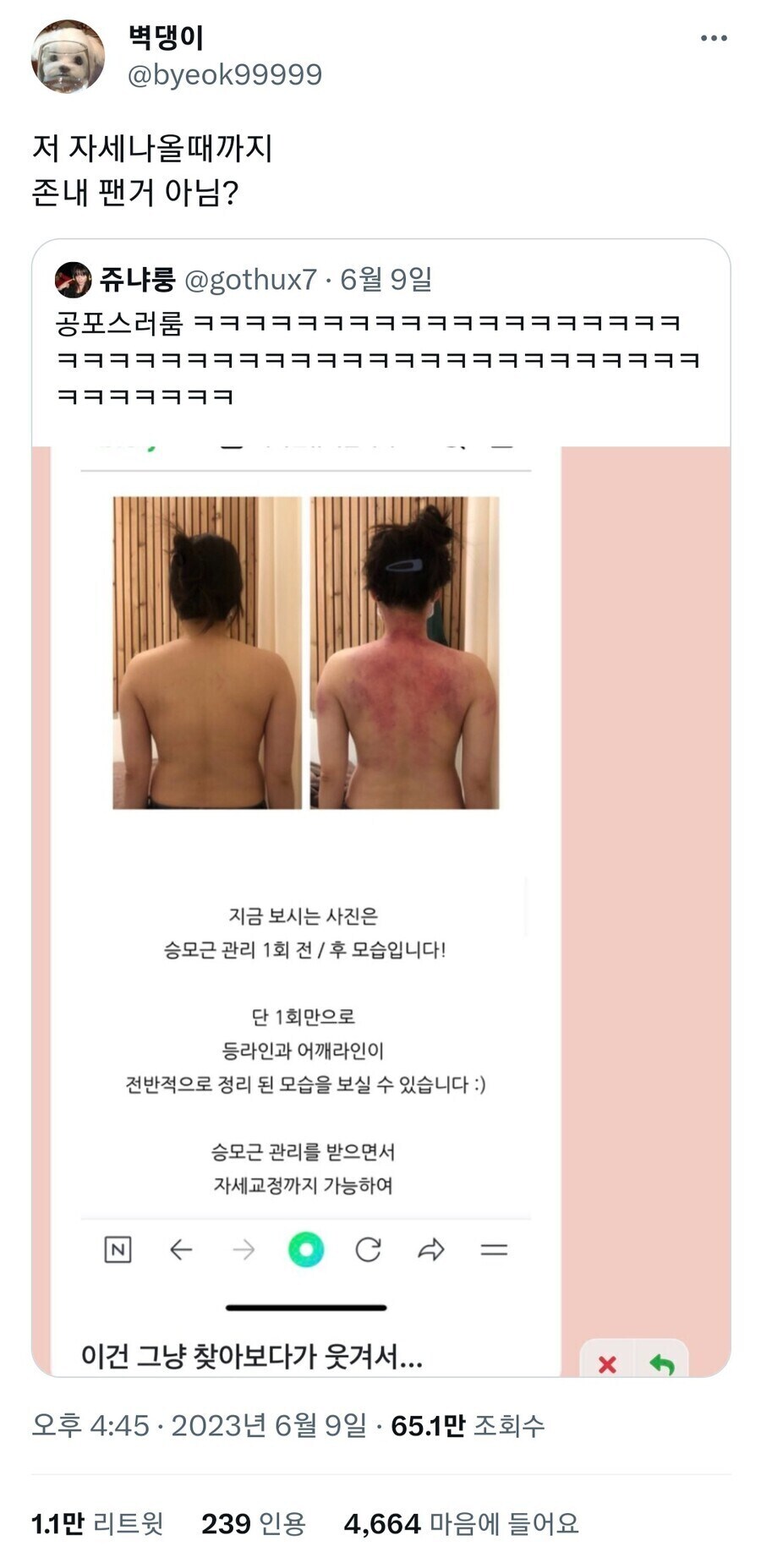 승모근 관리 1회만으로 어깨 라인이 정리 된 걸 알 수 있습니다!.jpg _1.jpg