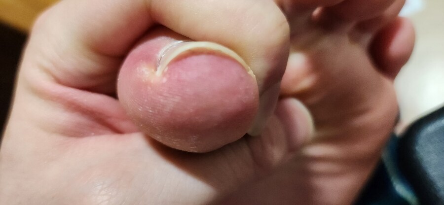 약혐) 내성발톱 어케 치료함?_1.jpg