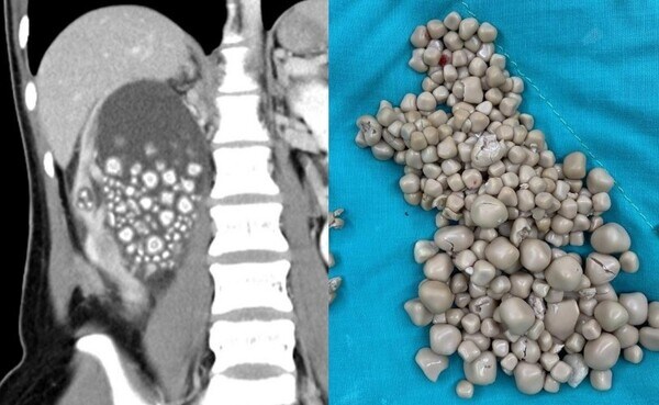 혐)물대신 액상과당 음료 마시다가 신장결석 300개 나온 여성_1.jpg