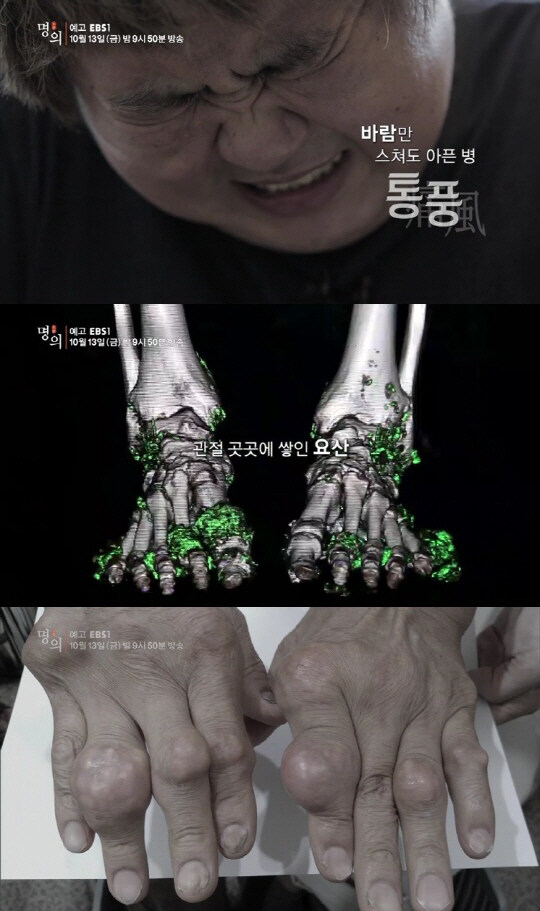 혐)통풍의 메커니즘_5.jpg