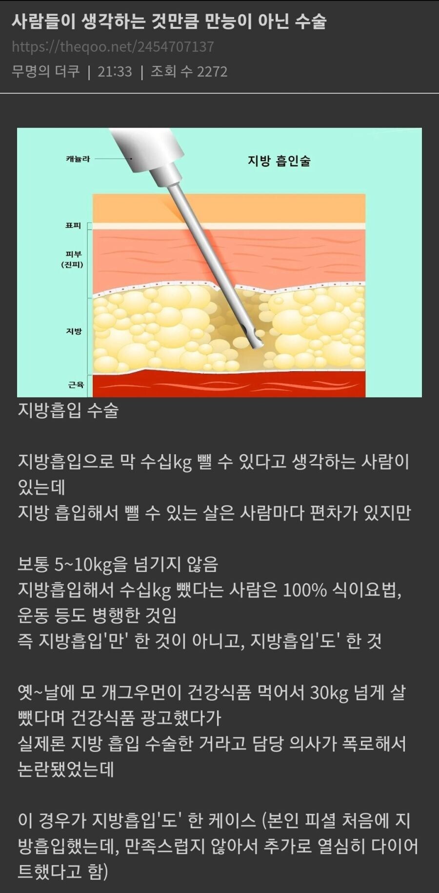 지방 흡입 수술에 대한 오해.jpg_1.jpg