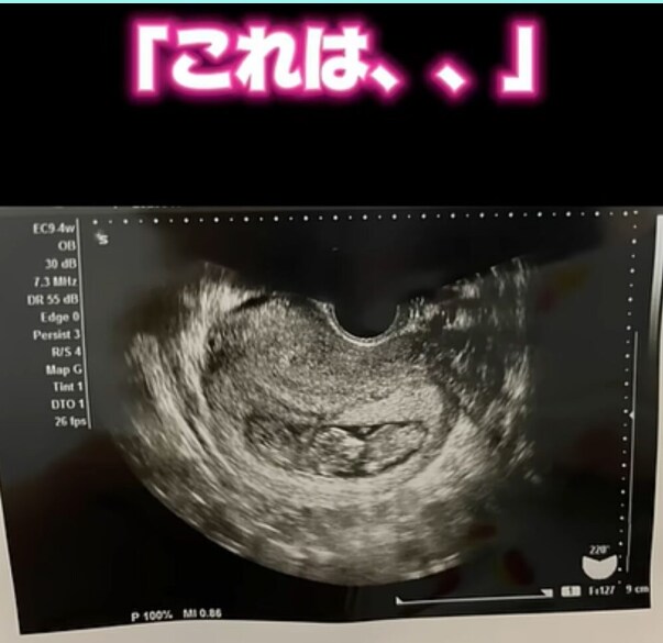 쌍둥이 임신 소식에 기뻣던 엄마 근황., jpg_2.png