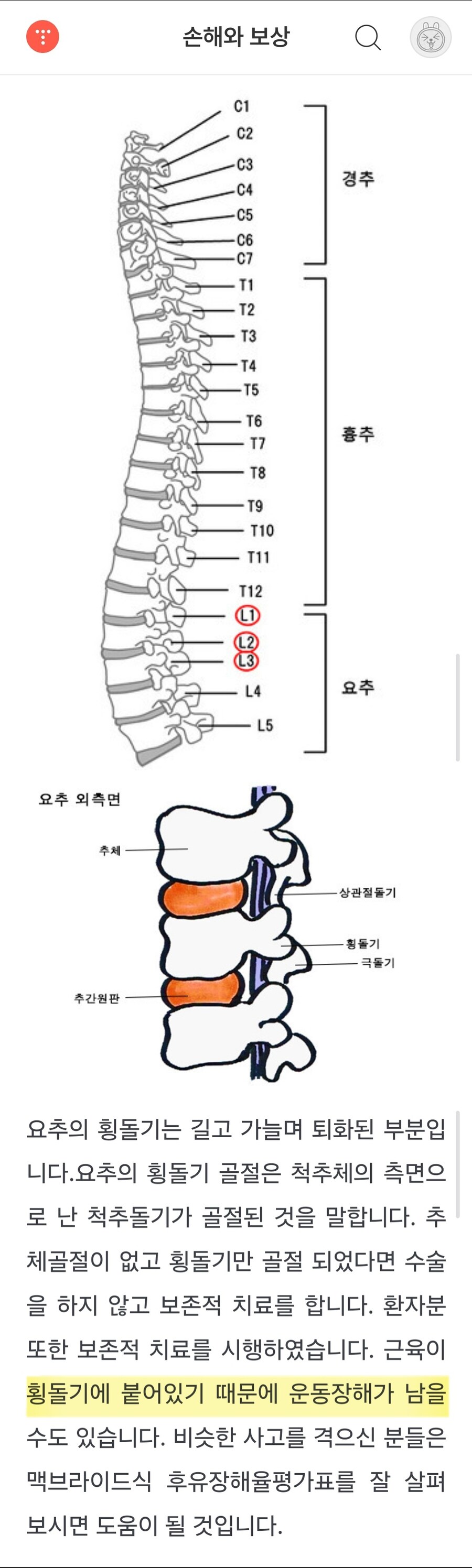 황동하 허리뼈 2번과 3번 횡돌기 골절, 6주 동안 보조기를 착용해야 함_2.jpg