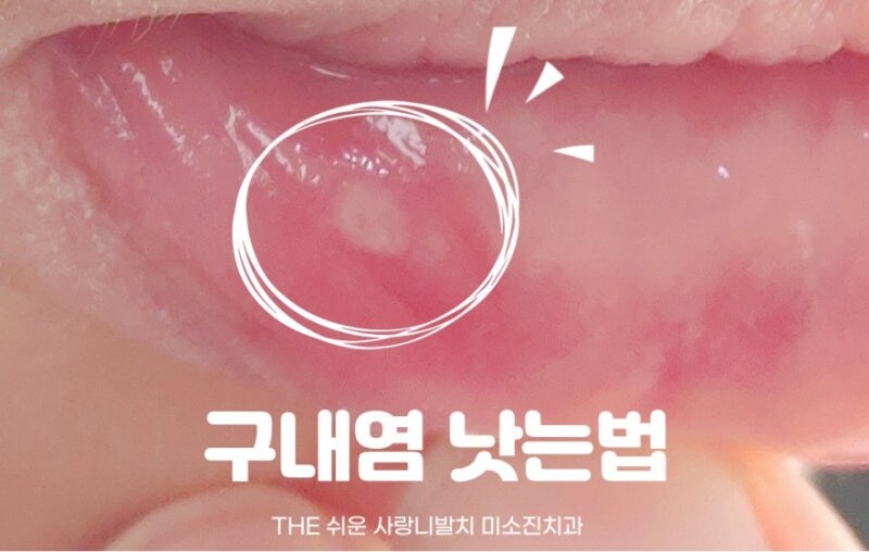 상남자식 구내염 다스리기_1.jpg