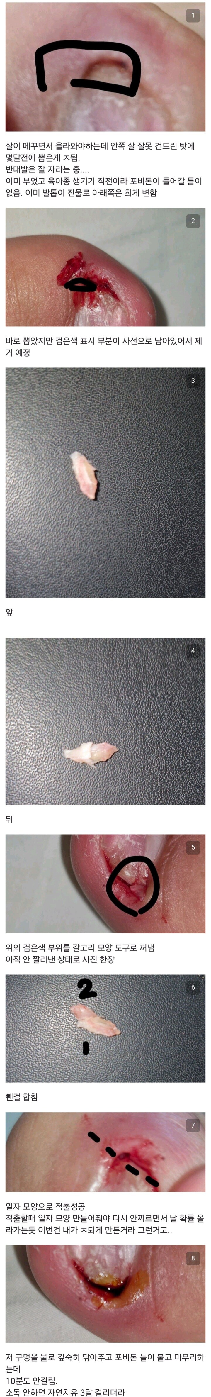 혐) 내성발톱 갤러리 신작_2.jpg