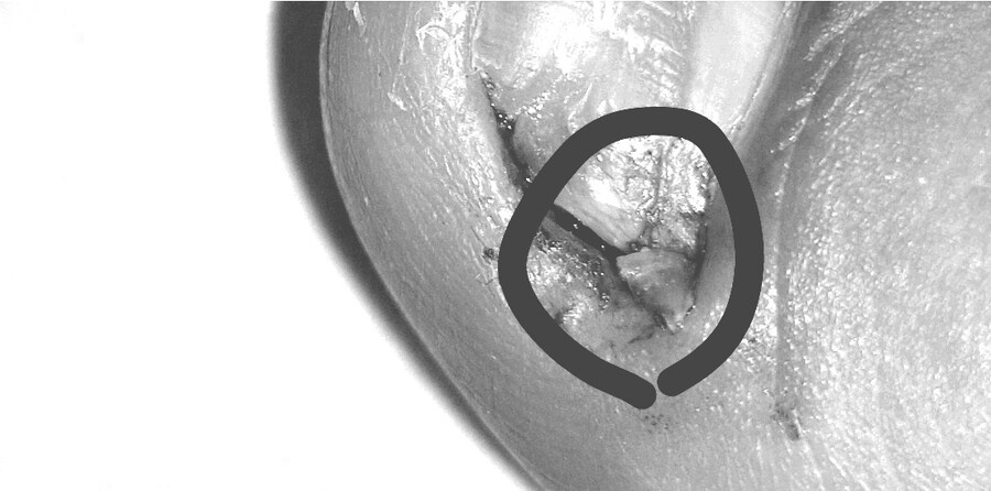 혐) 내성발톱 모음집_8.jpg