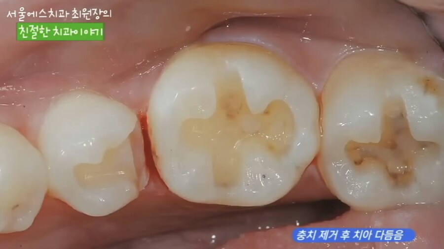 충치 치료 과정.jpg_3.jpg