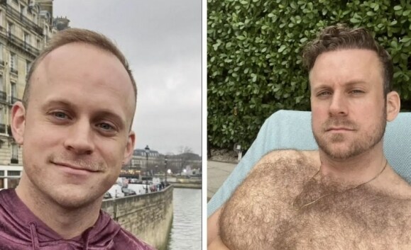 여행 다녀오면 머리숱 풍성”…300만원 이 나라 ‘탈모투어’ 뜬다_1.jpg