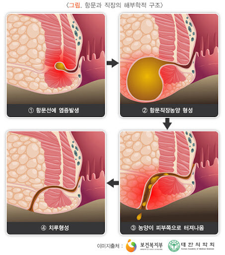 정정) 베글에 이홍기 질병 관련 이상한 소리 있어서 정정함_2.jpg