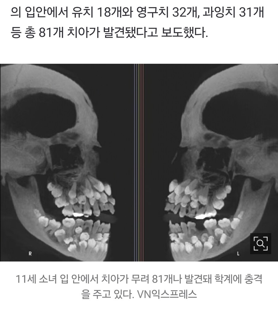 혐 주의) 81개 치아가 자란 입상태 ㄷㄷㄷㄷ_2.jpg