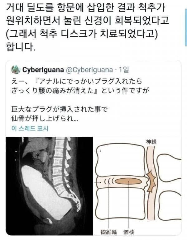 디스크 치료의 신기원