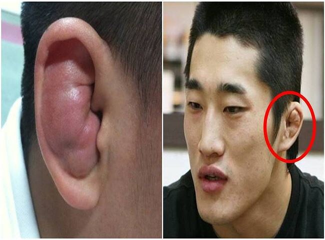 만두귀 의외로 많은 사람들이 착각 하는 것_1.jpg