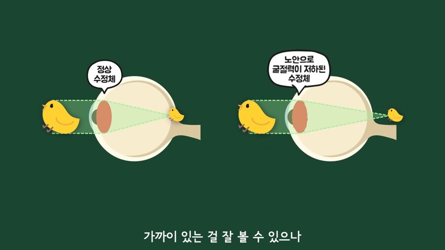 안과 의사들이 안경을 쓰는 이유.jpg_17.png