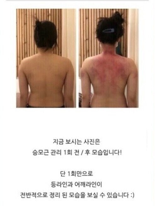 승모근 교정이 잘되는 이유 甲.jpg_1.jpg