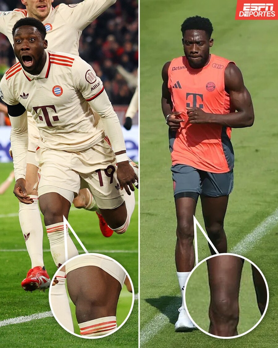 어느 축구 선수의 십자인대 수술 후 허벅지