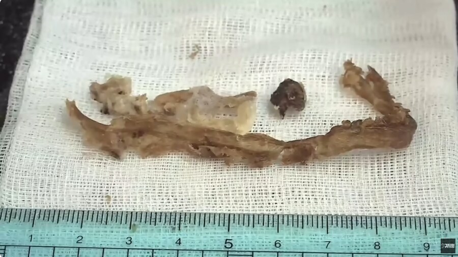 혐)역대급 크기 귀지_1.png