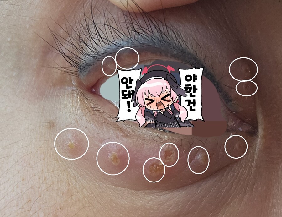약혐?)앗 시발 헤르페스가 눈에도 생길수 있는거였구나_1.jpg