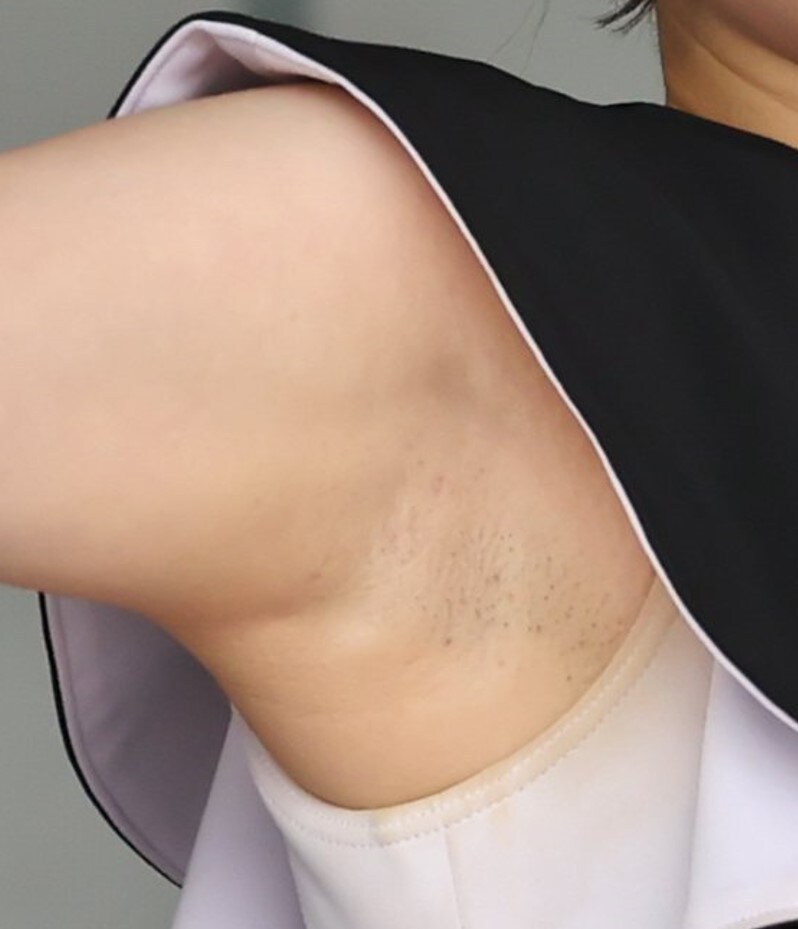 호불호 있는 겨드랑이 상태_9.jpg