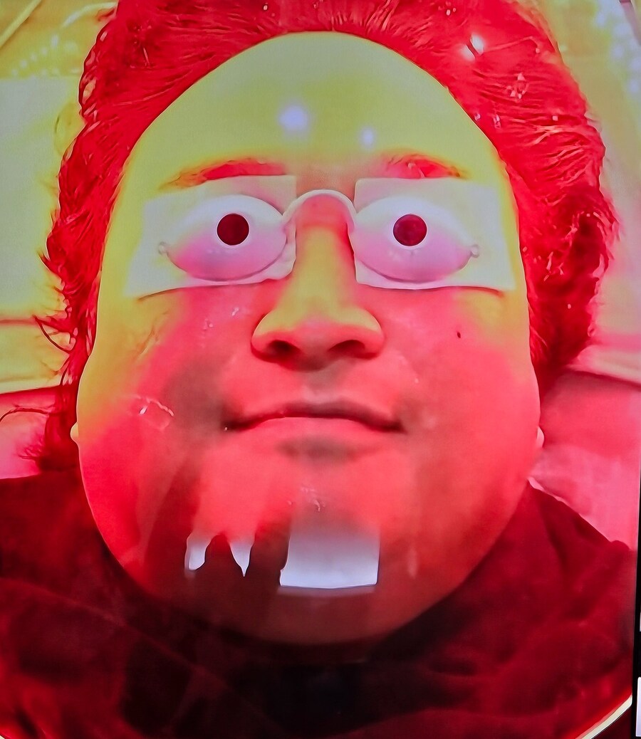 나혼산) 나혼산 멤버의 백반증 치료 화면_3.jpg