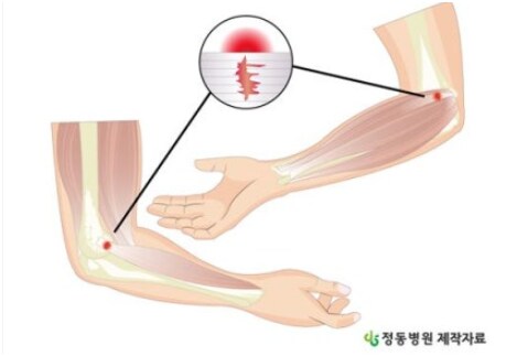 헬스 2일 했는데 팔오금 너무 아퍼_1.png