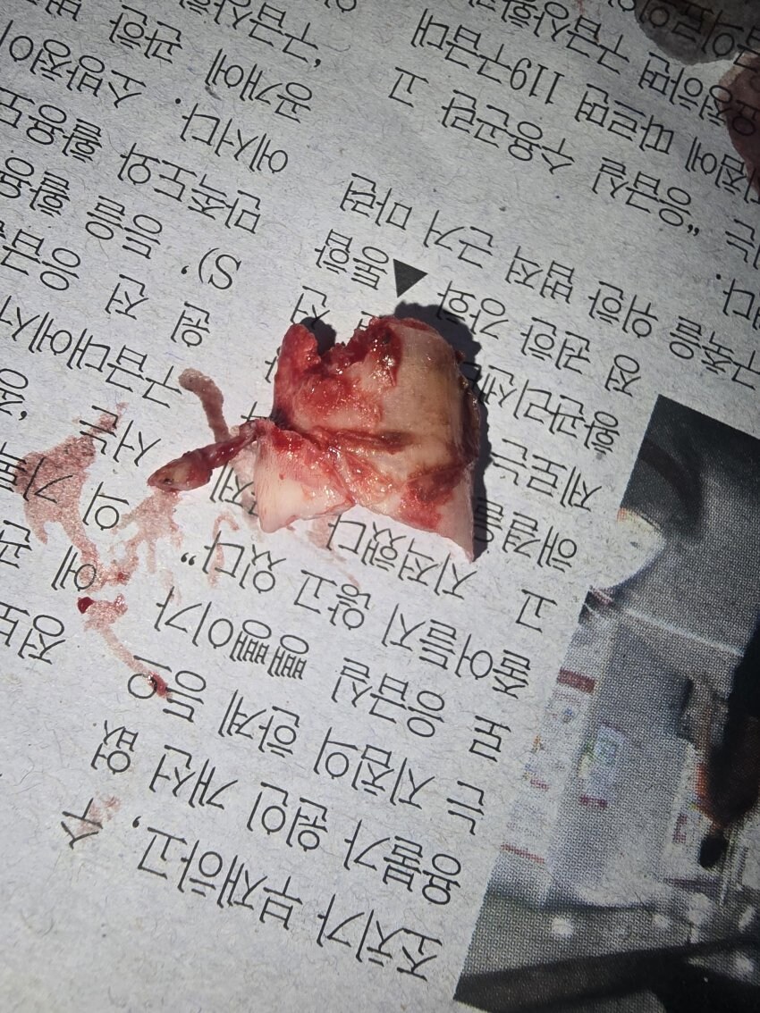 혐) 새벽을 일깨우는 내성발톱, 통풍, 사마귀_1.jpg