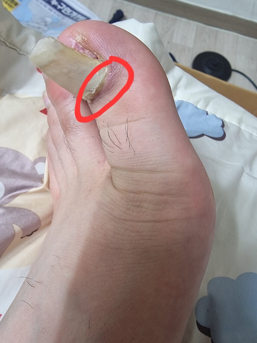 혐) 새벽을 일깨우는 내성발톱, 통풍, 사마귀_2.jpg