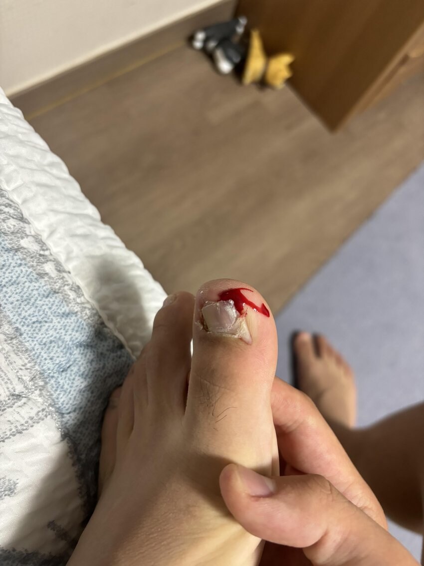 혐) 새벽을 일깨우는 내성발톱, 통풍, 사마귀_4.jpg